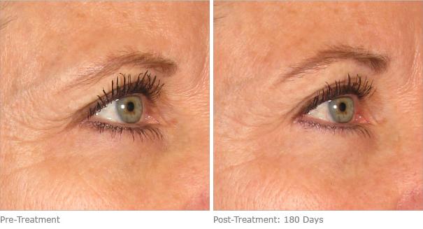 Before and After Image: Ulthera Lift Before and After Photos in Houston, TX, Patient 8230 - right-front-oblique