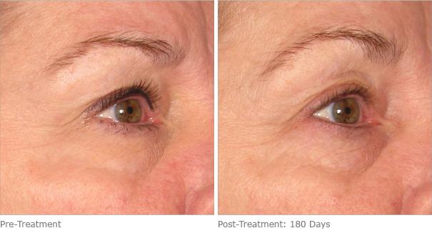 Before and After Image: Ulthera Lift Before and After Photos in Houston, TX, Patient 8233 - right-front-oblique