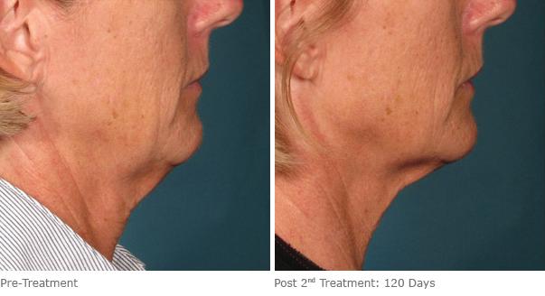 Before and After Image: Ulthera Lift Before and After Photos in Houston, TX, Patient 8208 - right-side