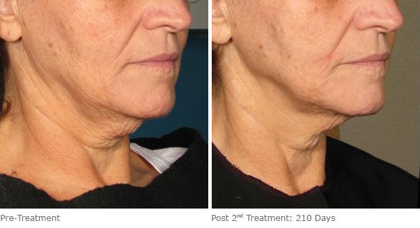 Before and After Image: Ulthera Lift Before and After Photos in Houston, TX, Patient 8208 - right-front-oblique
