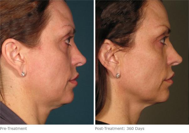 Before and After Image: Ulthera Lift Before and After Photos in Houston, TX, Patient 8213 - right-side