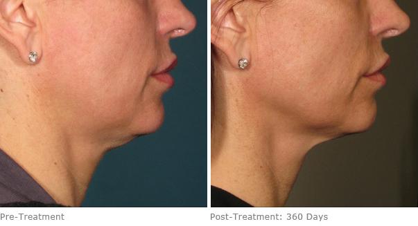Before and After Image: Ulthera Lift Before and After Photos in Houston, TX, Patient 8213 - right-side