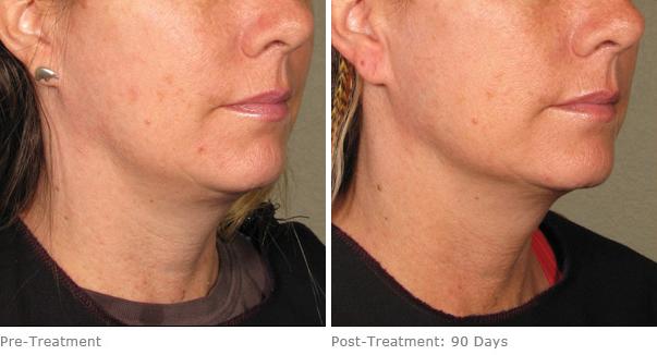 Before and After Image: Ulthera Lift Before and After Photos in Houston, TX, Patient 8242 - right-front-oblique