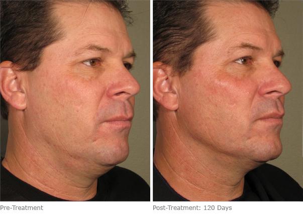 Before and After Image: Ulthera Lift Before and After Photos in Houston, TX, Patient 8245 - right-front-oblique