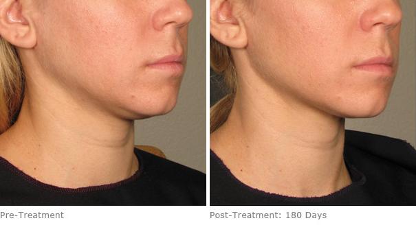 Before and After Image: Ulthera Lift Before and After Photos in Houston, TX, Patient 8305 - 