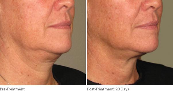 Before and After Image: Ulthera Lift Before and After Photos in Houston, TX, Patient 8279 - right-front-oblique
