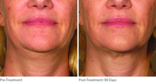Before and After Image: Ulthera Lift Before and After Photos in Houston, TX, Patient 8290 - front