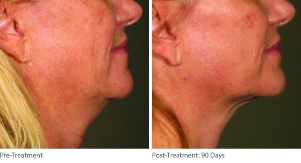 Before and After Image: Ulthera Lift Before and After Photos in Houston, TX, Patient 8290 - front
