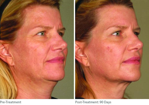 Before and After Image: Ulthera Lift Before and After Photos in Houston, TX, Patient 8290 - right-front-oblique