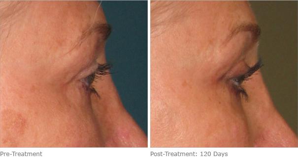 Before and After Image: Ulthera Lift Before and After Photos in Houston, TX, Patient 8337 - right-side