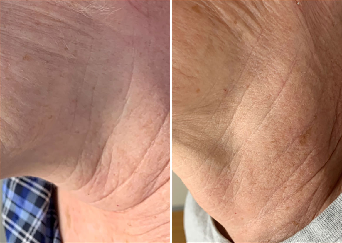 Before and After Image: SkinPen® Microneedling Before and After Photos in Houston, TX, Patient 13642 - left-side