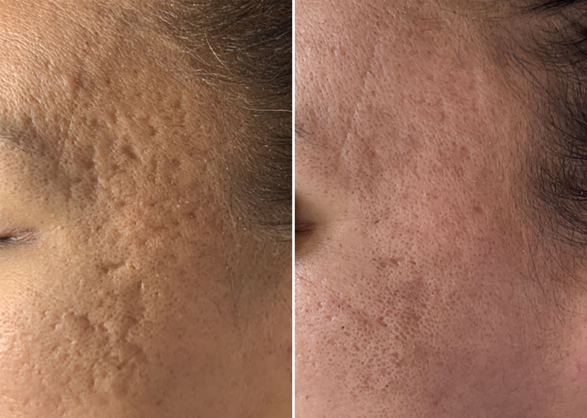 Before and After Image: SkinPen® Microneedling Before and After Photos in Houston, TX, Patient 13638 - left-front-oblique