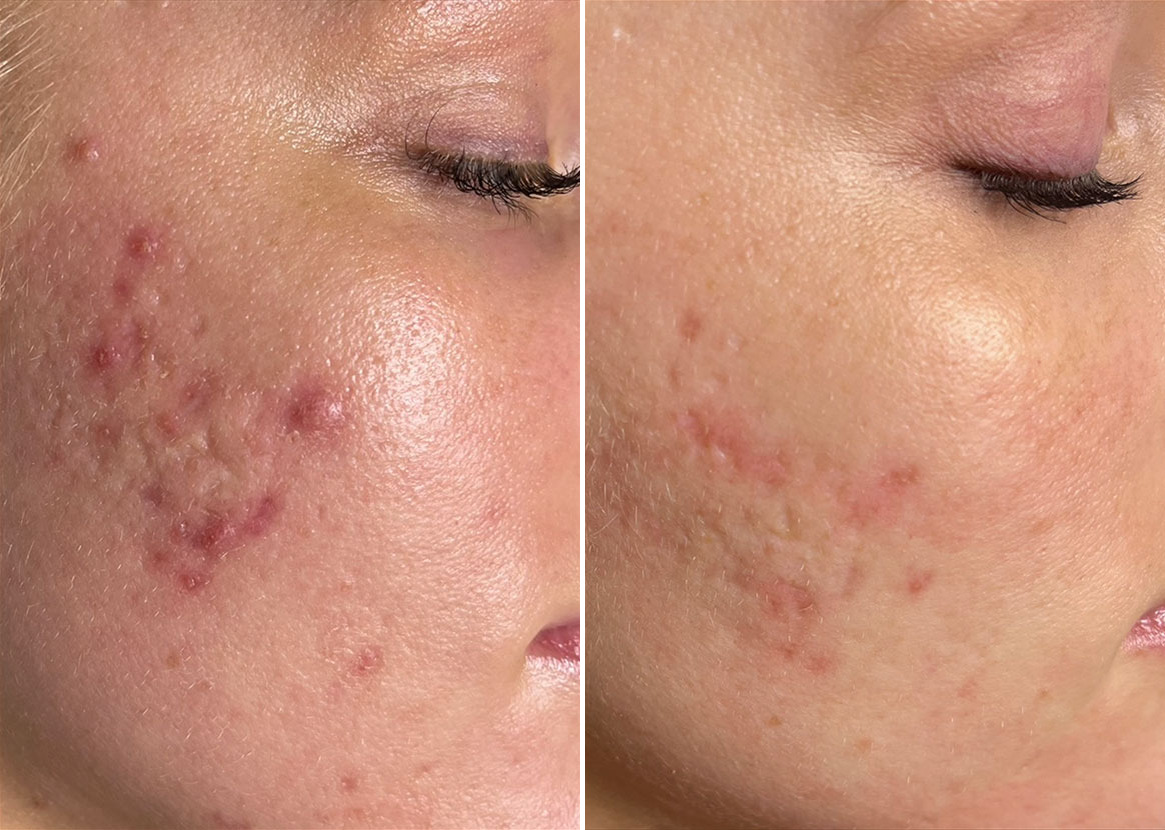 Before and After Image: SkinPen® Microneedling Before and After Photos in Houston, TX, Patient 13631 - right-front-oblique