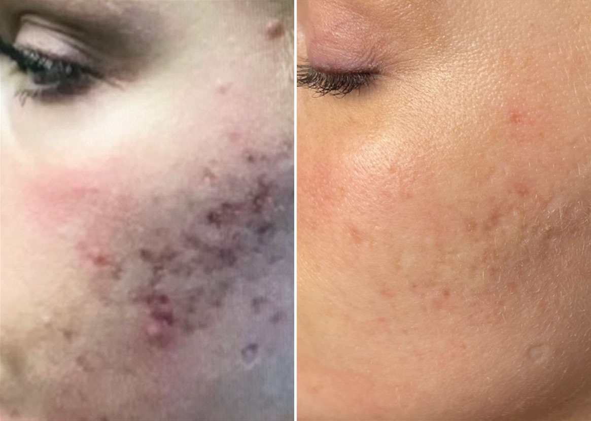 Before and After Image: SkinPen® Microneedling Before and After Photos in Houston, TX, Patient 13631 - left-front-oblique