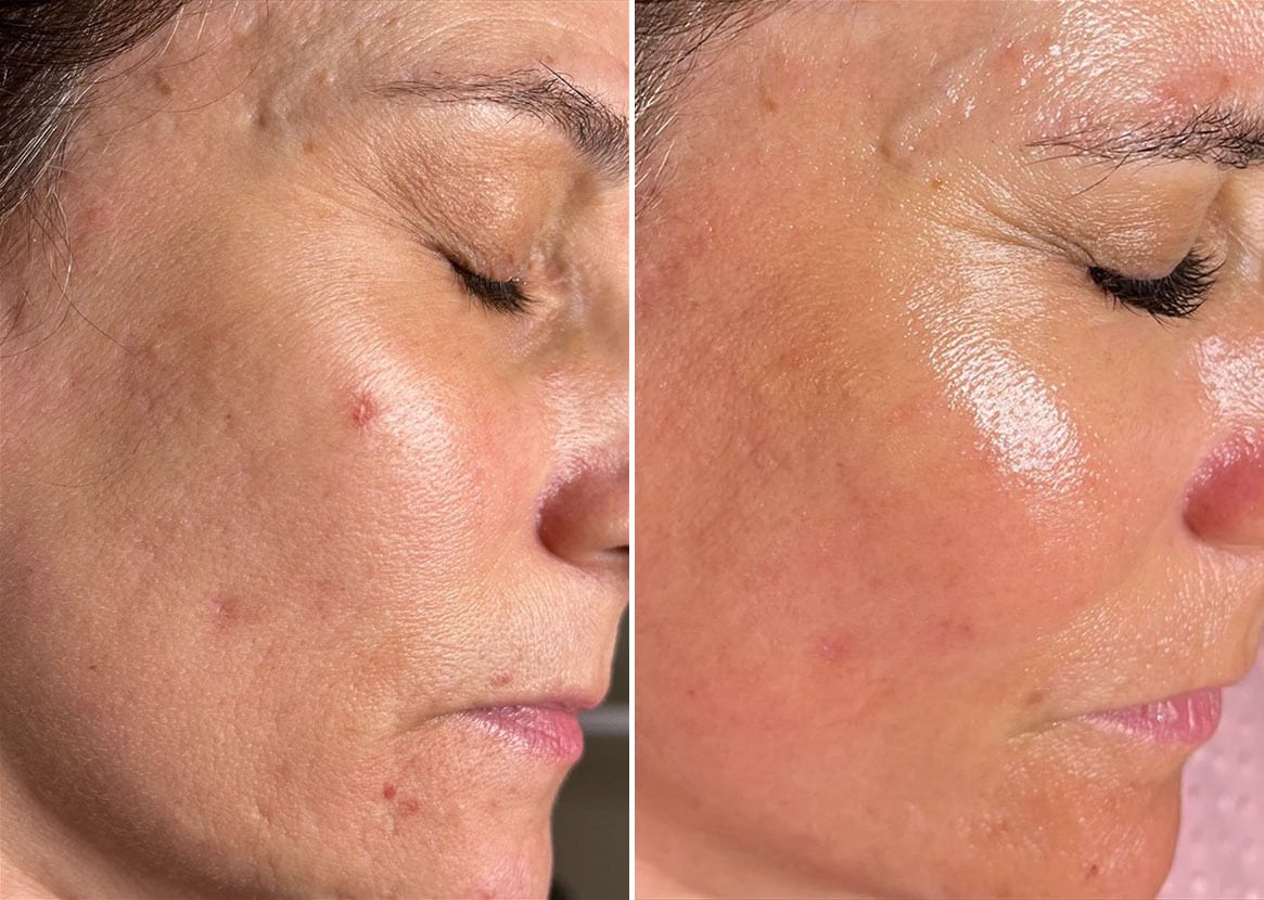 SkinPen Microneedling Before And After Photos In Houston TX Patient 