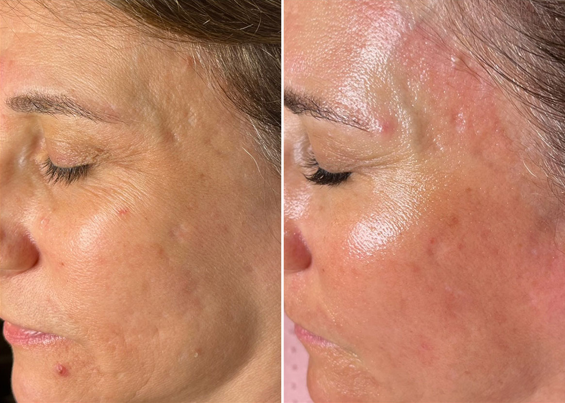 Before and After Image: SkinPen® Microneedling Before and After Photos in Houston, TX, Patient 13628 - left-side