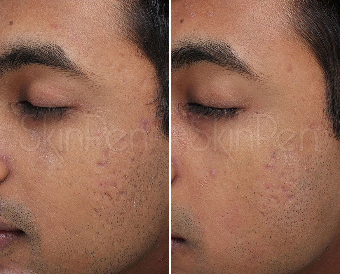 Before and After Image: SkinPen® Microneedling Before and After Photos in Houston, TX, Patient 13701 - left-front-oblique