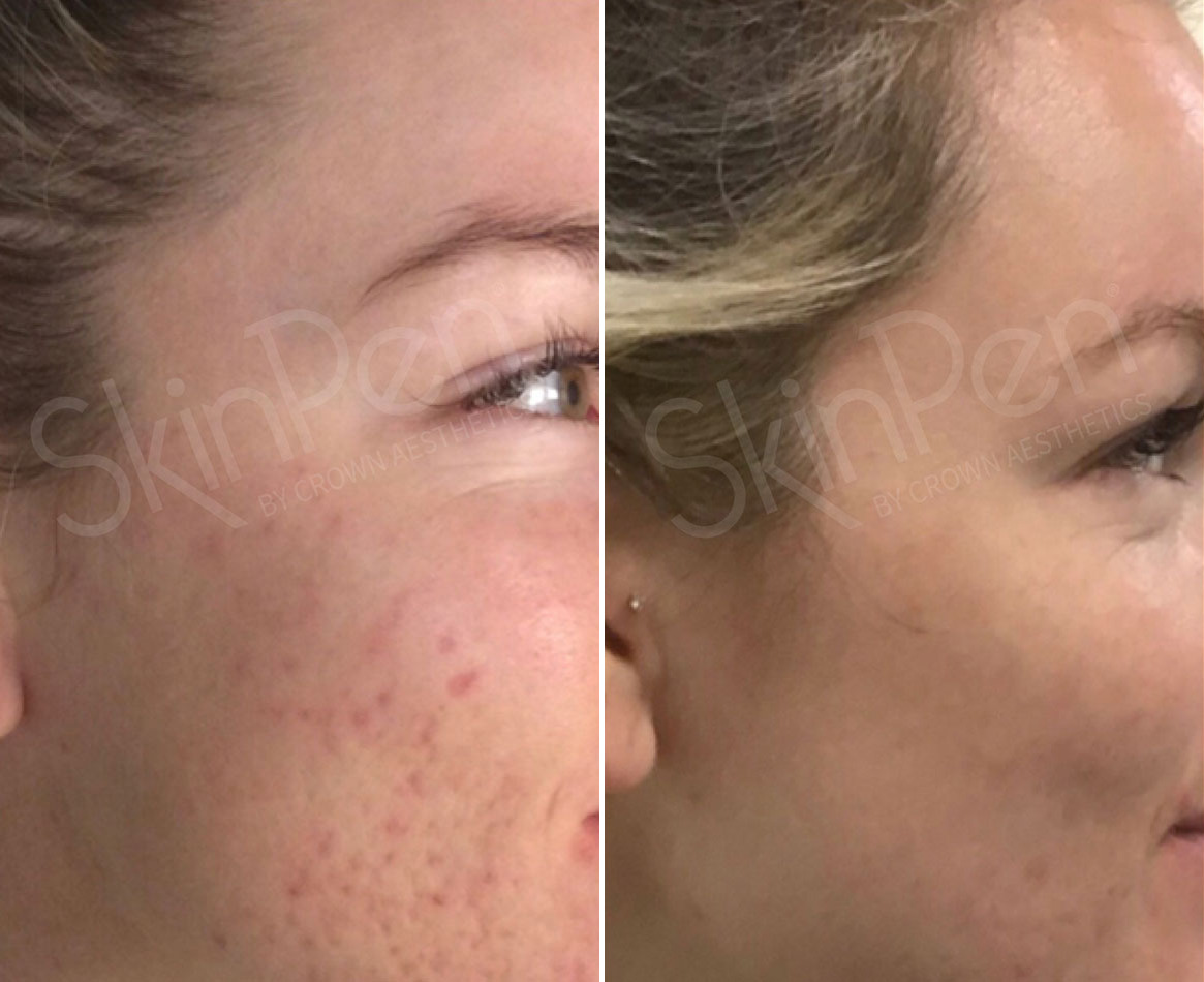 Before and After Image: SkinPen® Microneedling Before and After Photos in Houston, TX, Patient 13686 - right-side