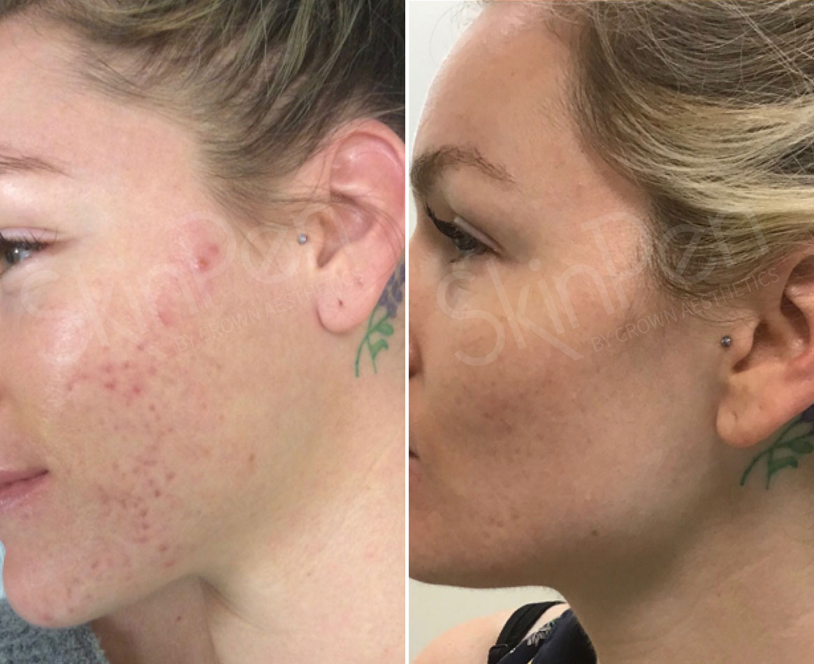 Before and After Image: SkinPen® Microneedling Before and After Photos in Houston, TX, Patient 13686 - left-side