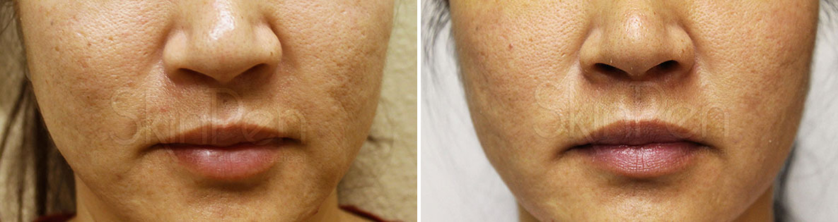Before and After Image: SkinPen® Microneedling Before and After Photos in Houston, TX, Patient 13682 - front