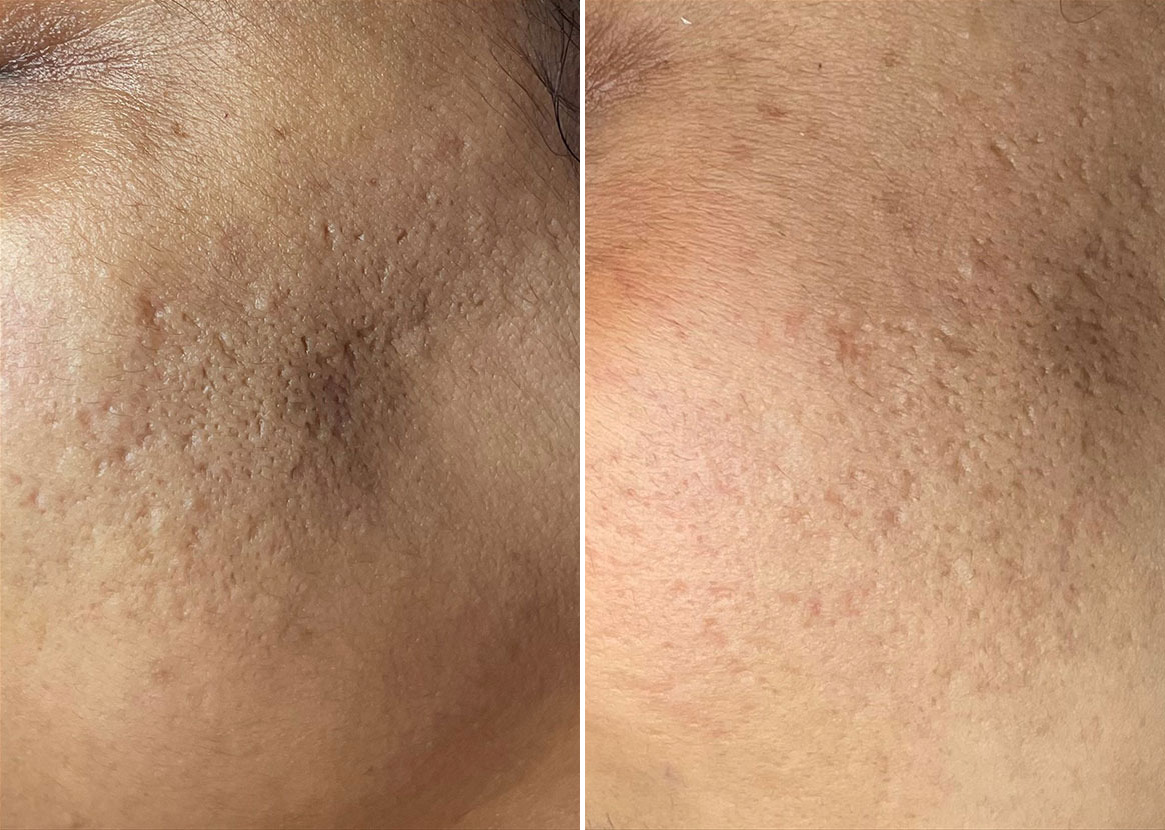 Before and After Image: SkinPen® Microneedling Before and After Photos in Houston, TX, Patient 13674 - left-front-oblique