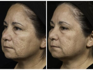 before after fraxel 2 1