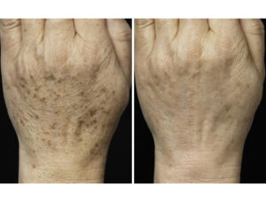 before after fraxel 3 1