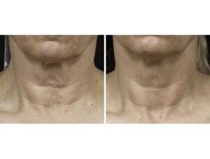 before after fraxel 4 1