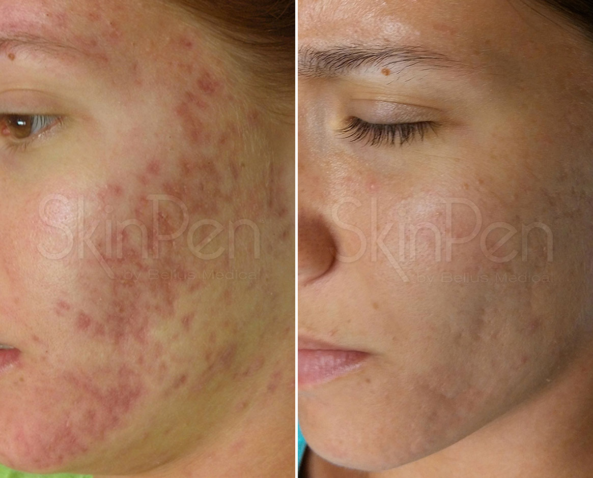 Before and After Image: SkinPen® Microneedling Before and After Photos in Houston, TX, Patient 13710 - left-front-oblique