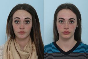 botox cosmetic 2