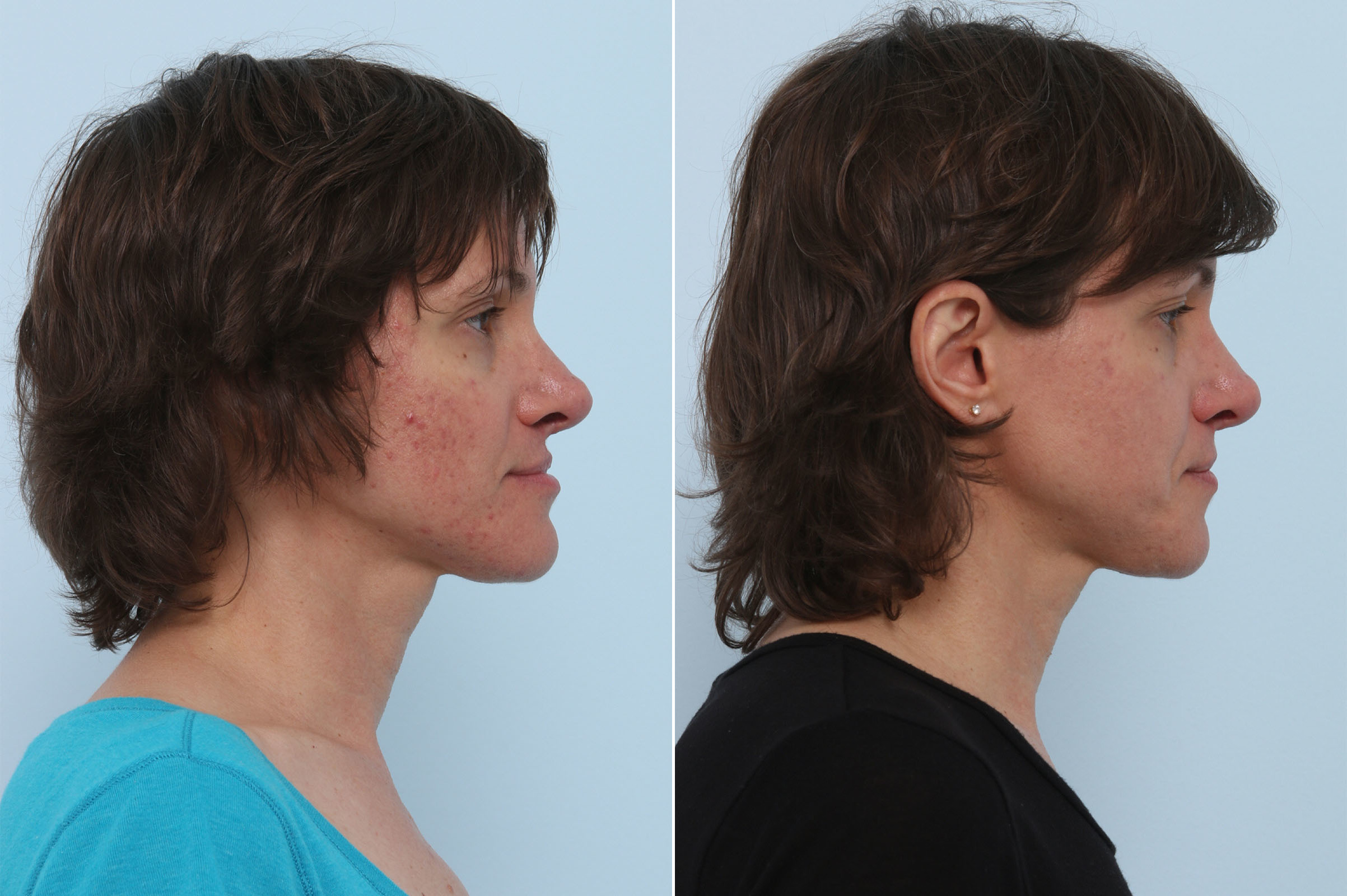 Before and After Image: Chemical Peels Before and After Photos in Houston, TX, Patient 10226 - right-side