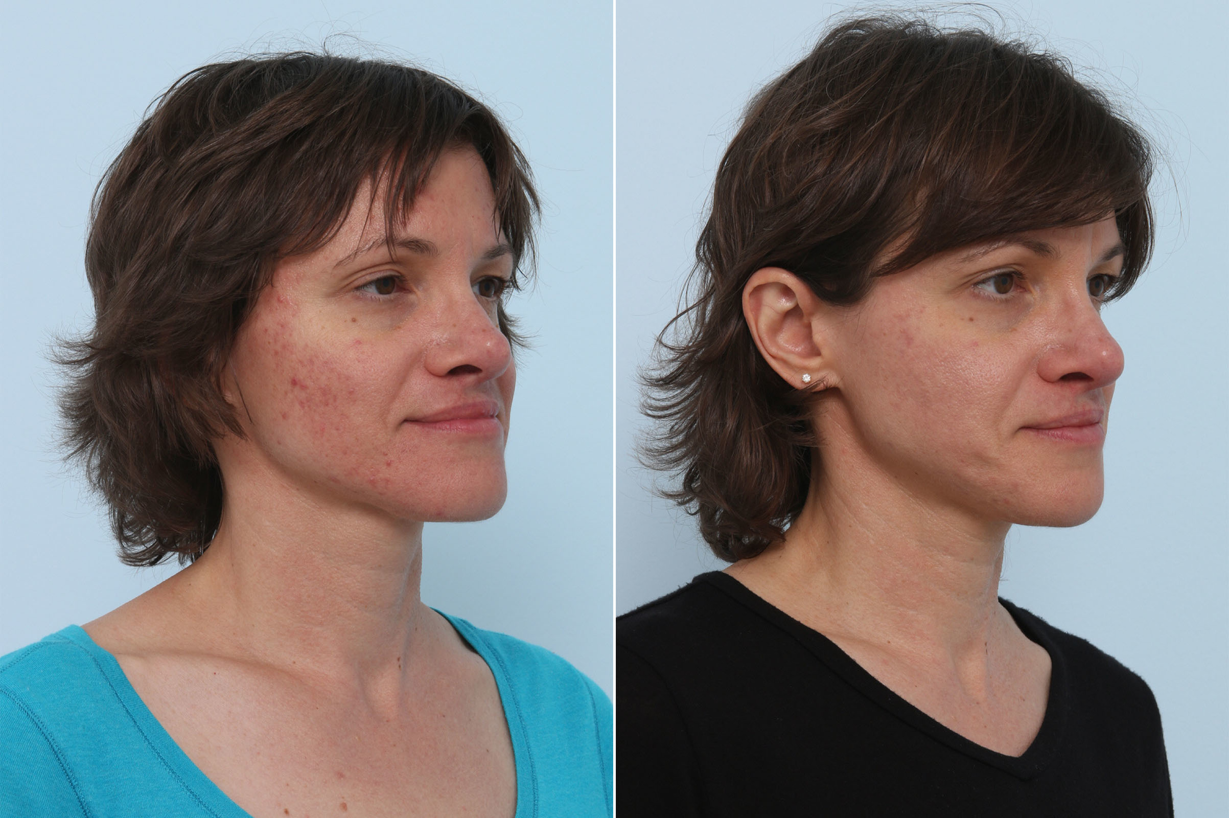 Before and After Image: Chemical Peels Before and After Photos in Houston, TX, Patient 10226 - right-front-oblique