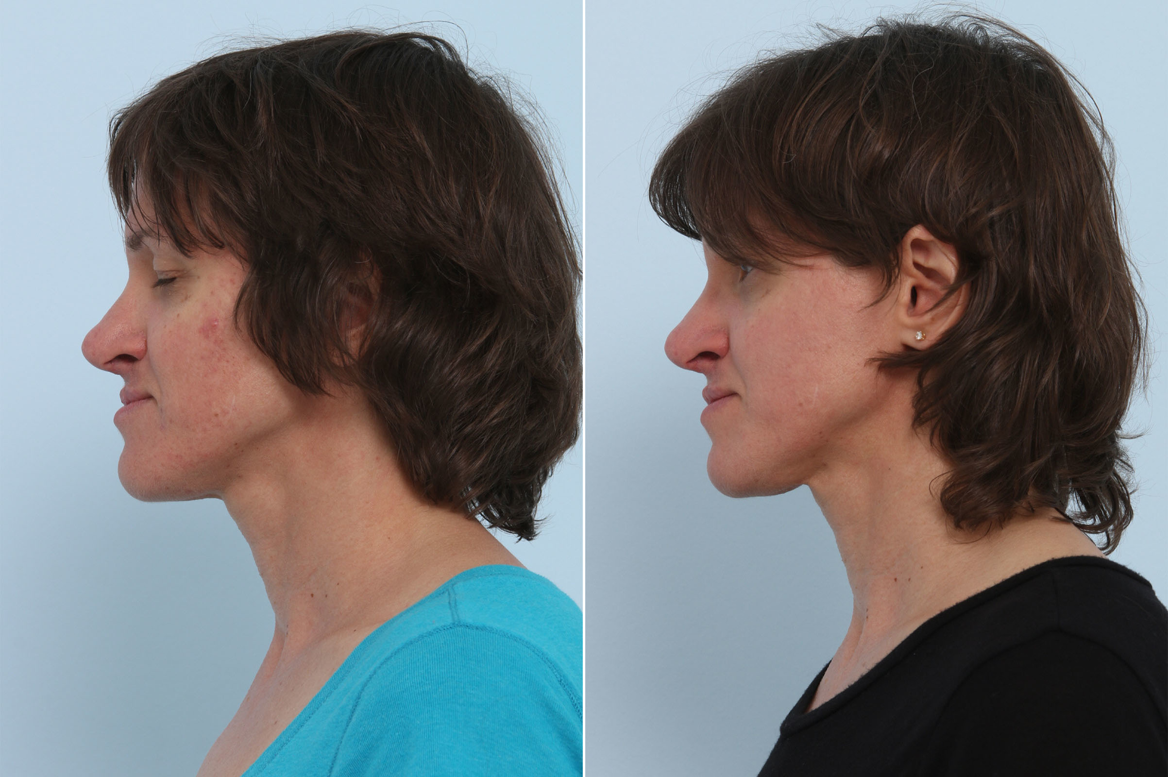Before and After Image: Chemical Peels Before and After Photos in Houston, TX, Patient 10226 - left-side