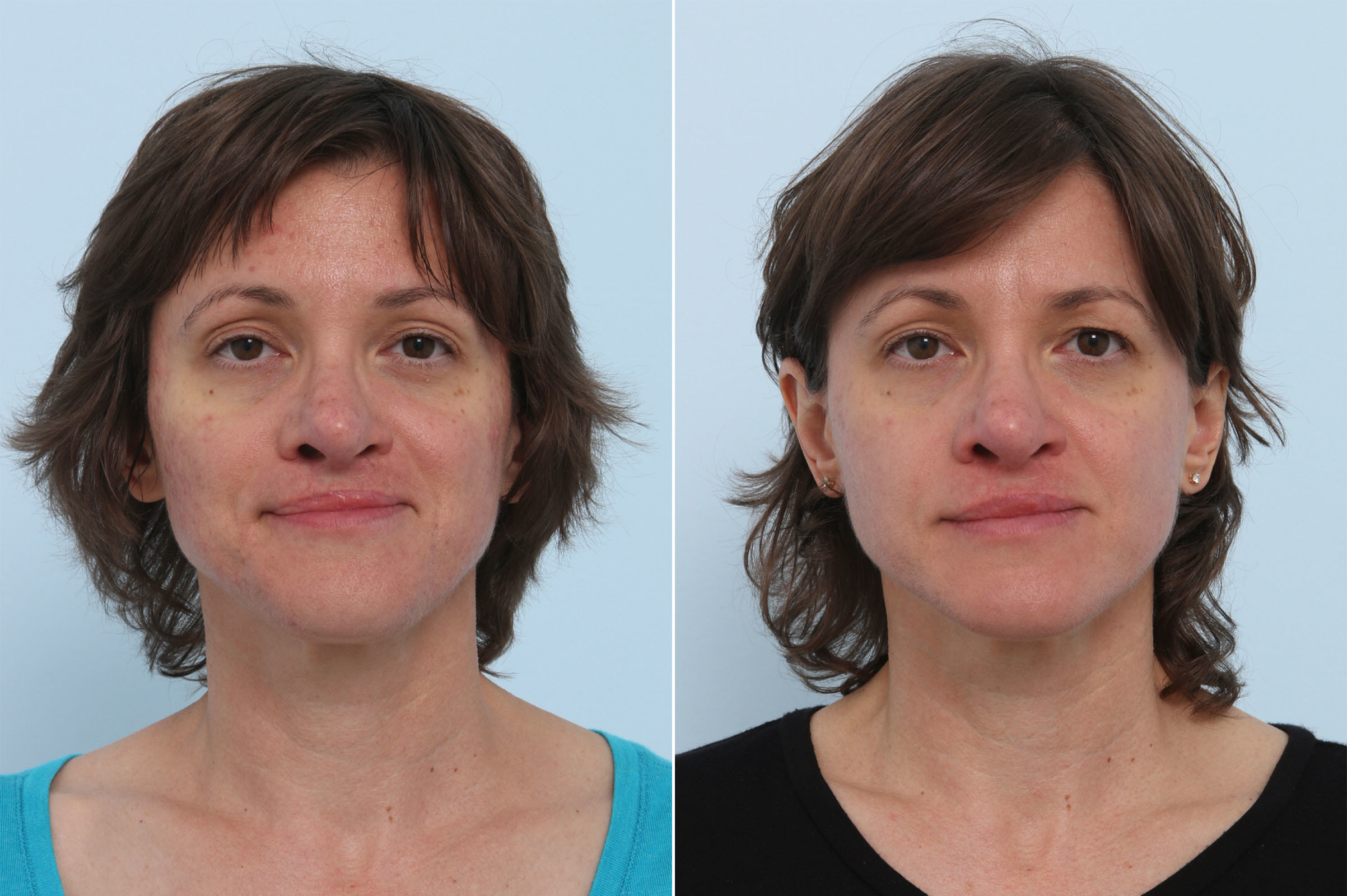 Before and After Image: Chemical Peels Before and After Photos in Houston, TX, Patient 10226 - front