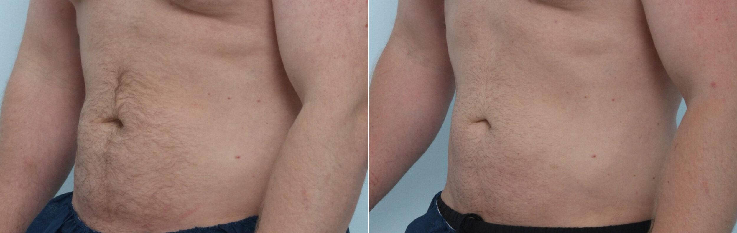 Before and After Image: CoolSculpting Before and After Photos in Houston, TX, Patient 9790 - left-front-oblique
