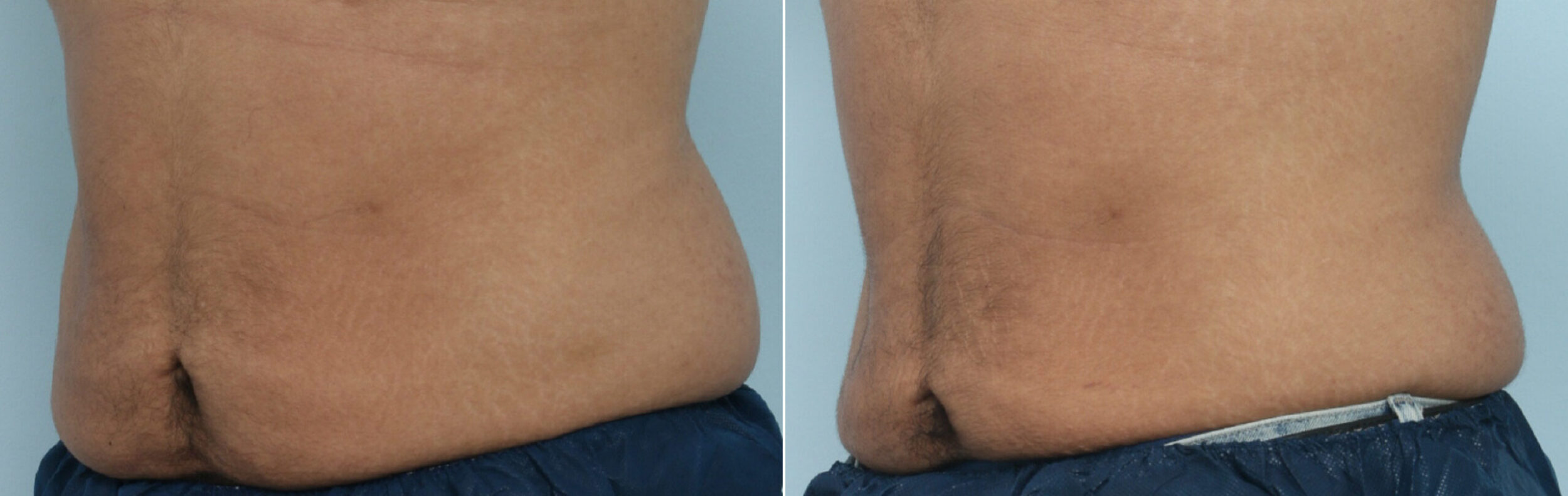 Before and After Image: CoolSculpting Before and After Photos in Houston, TX, Patient 9461 - left-front-oblique