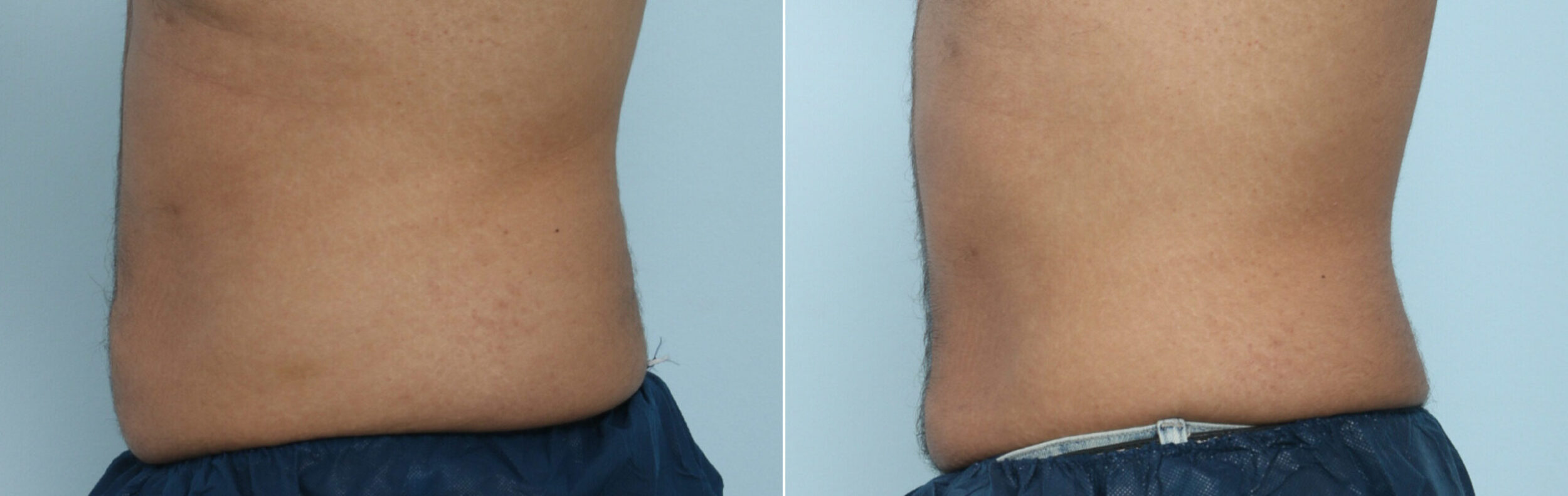 Before and After Image: CoolSculpting Before and After Photos in Houston, TX, Patient 9461 - left-side