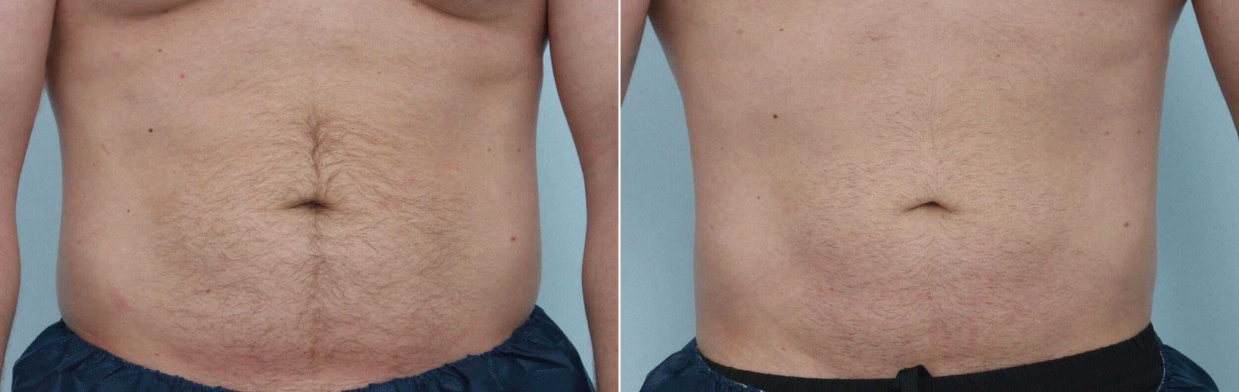 Before and After Image: CoolSculpting Before and After Photos in Houston, TX, Patient 9790 - front