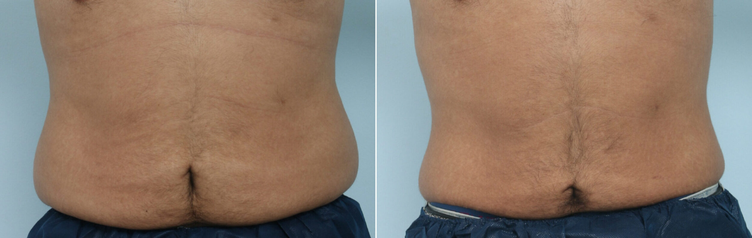 Before and After Image: CoolSculpting Before and After Photos in Houston, TX, Patient 9461 - front