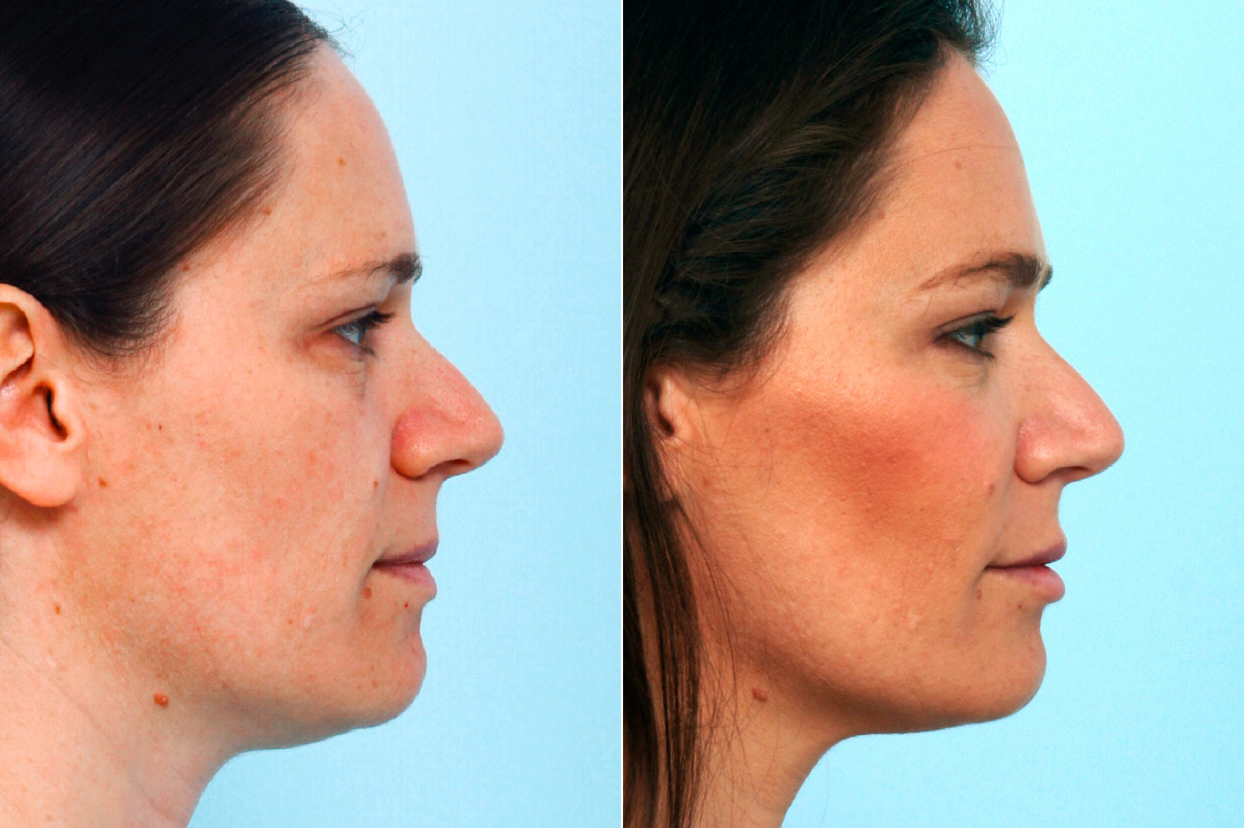 Before and After Image: Fillers Before and After Photos in Houston, TX, Patient 10157 - right-side