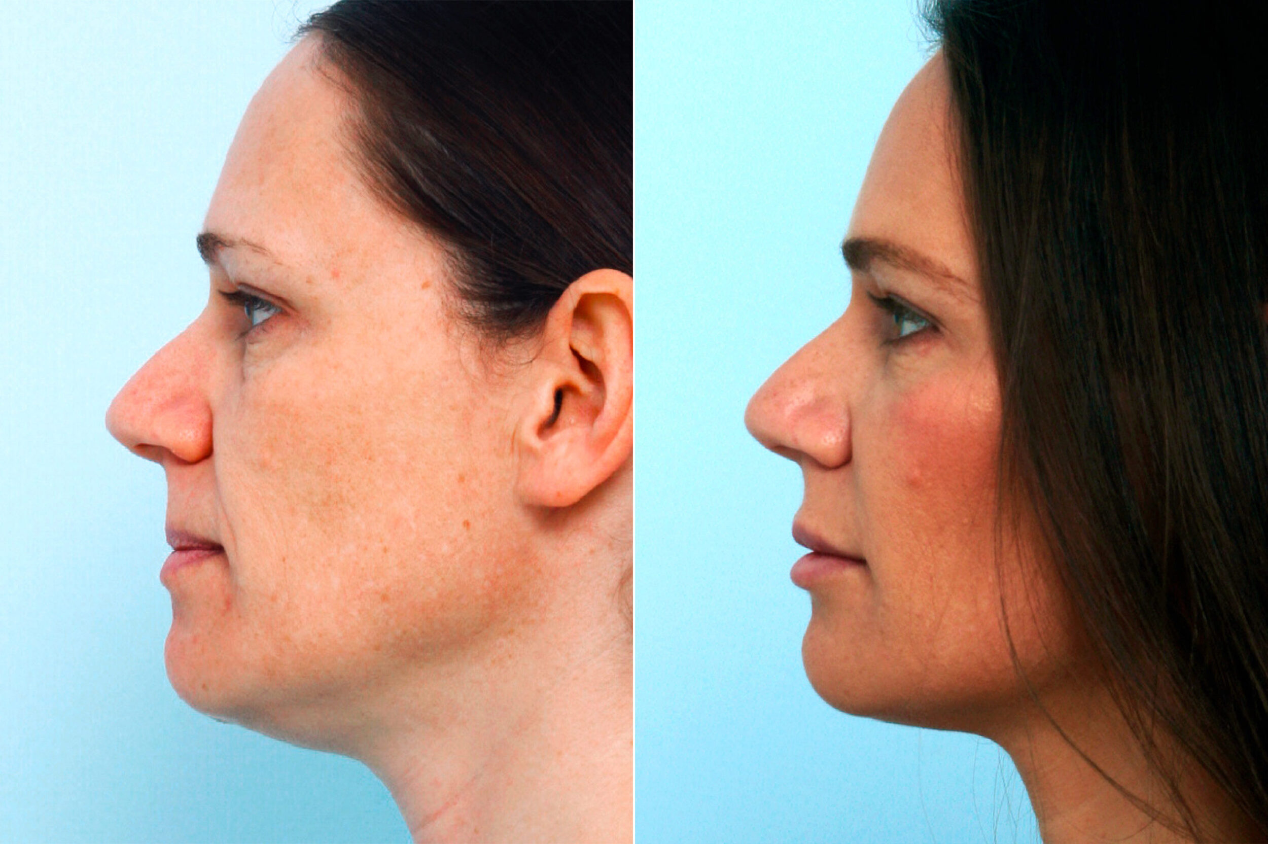 Before and After Image: Fillers Before and After Photos in Houston, TX, Patient 10157 - left-side
