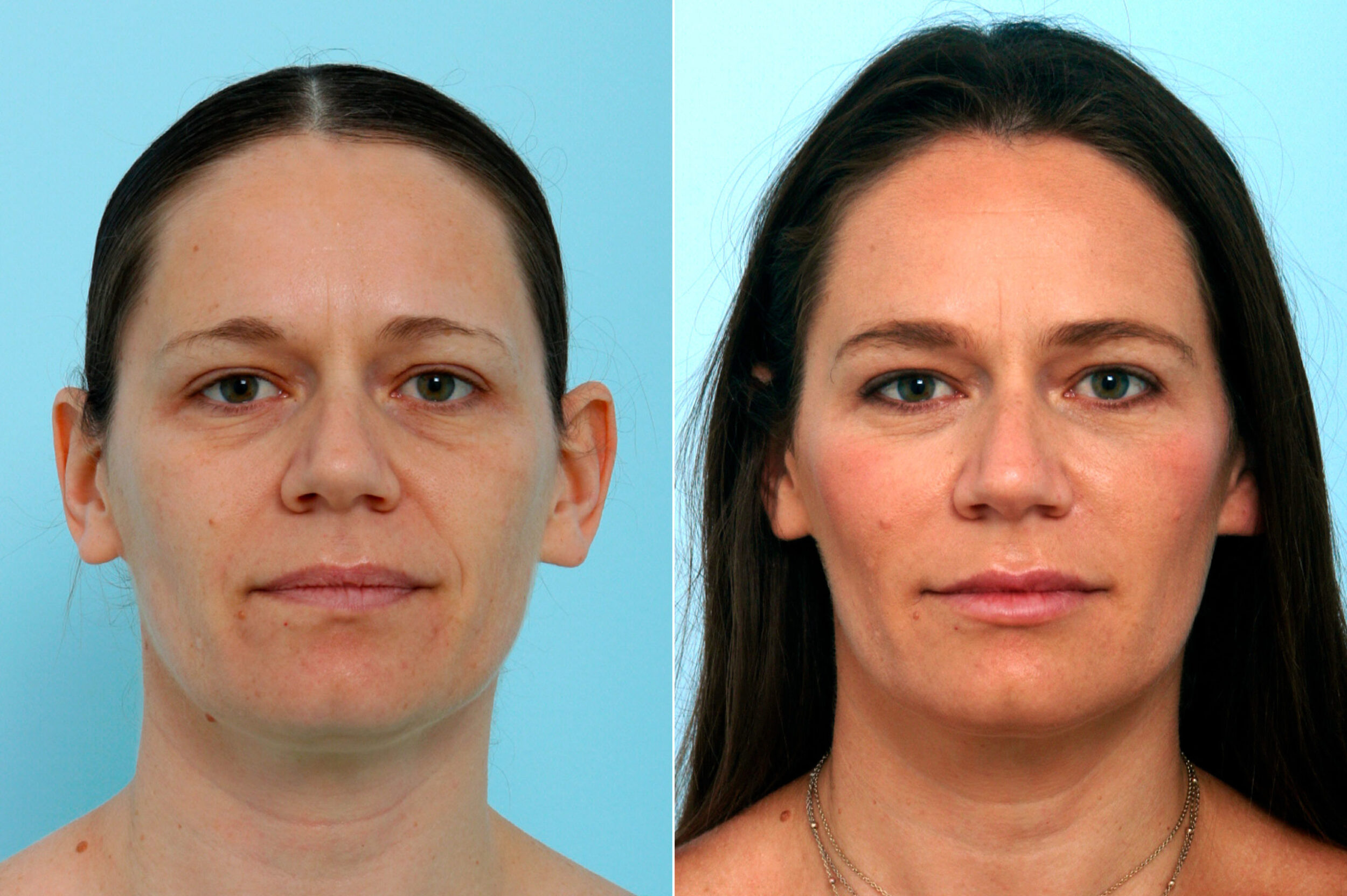 Before and After Image: Fillers Before and After Photos in Houston, TX, Patient 10157 - front