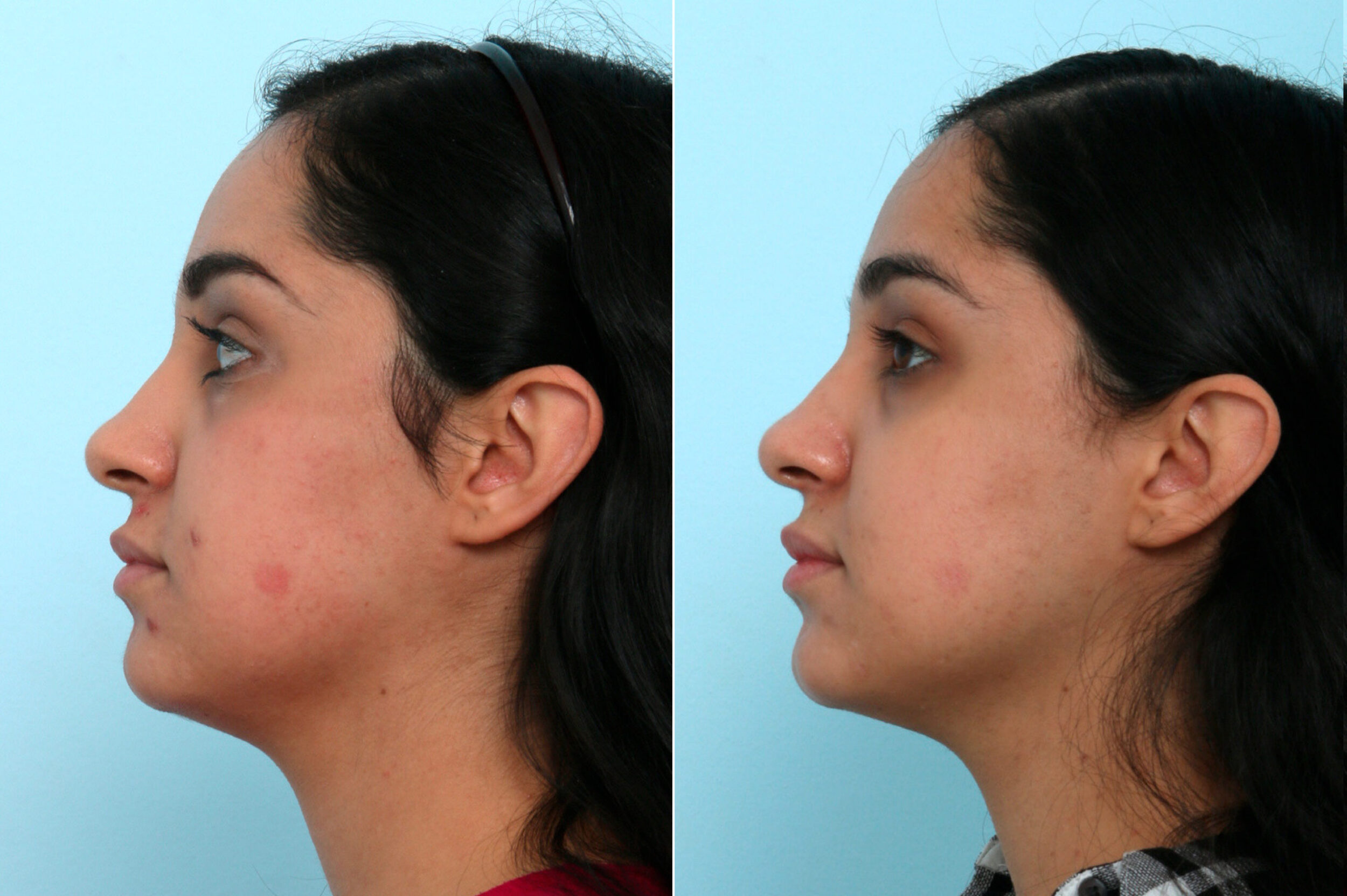 Before and After Image: Fraxel Laser Before and After Photos in Houston, TX, Patient 9801 - left-side
