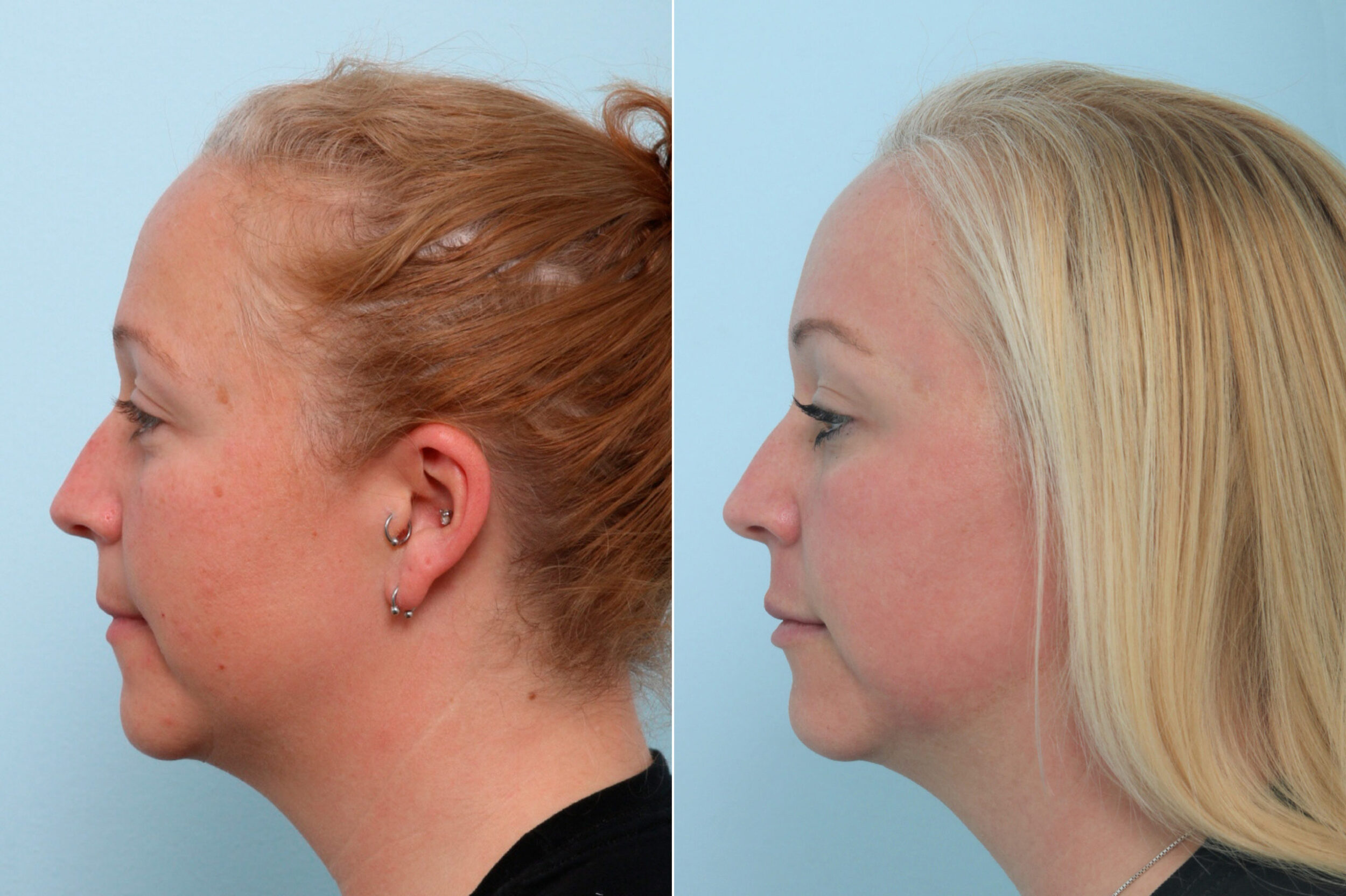 Before and After Image: Fraxel Laser Before and After Photos in Houston, TX, Patient 9770 - left-side