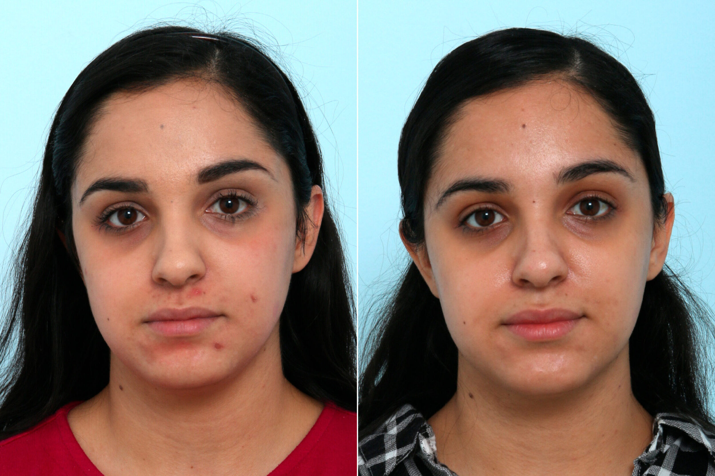 Before and After Image: Fraxel Laser Before and After Photos in Houston, TX, Patient 9801 - front