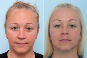 fraxel laser before after scaled