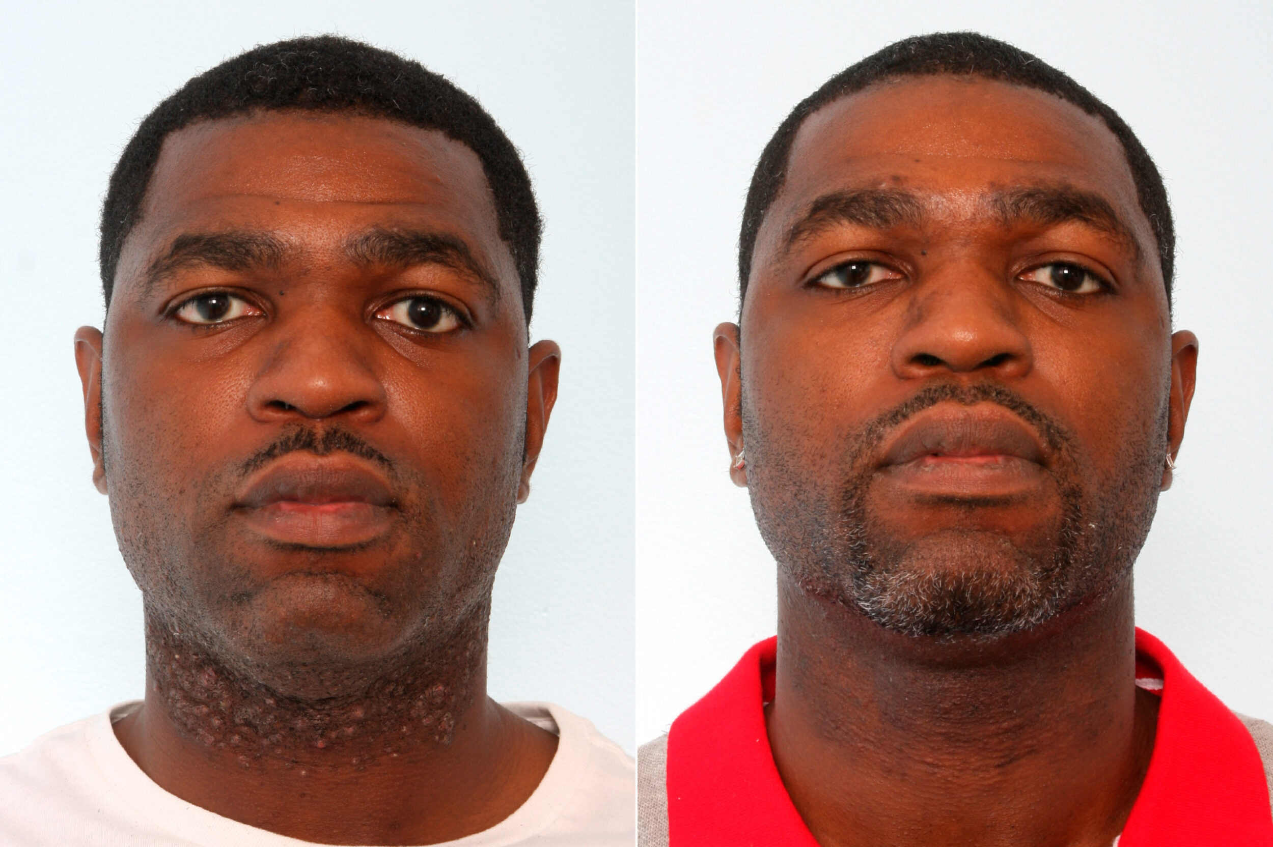 Before and After Image: Laser Hair Removal Before and After Photos in Houston, TX, Patient 10171 - front