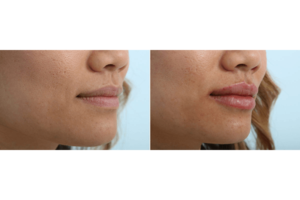 lip enhancement 3