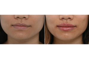lip enhancement 4