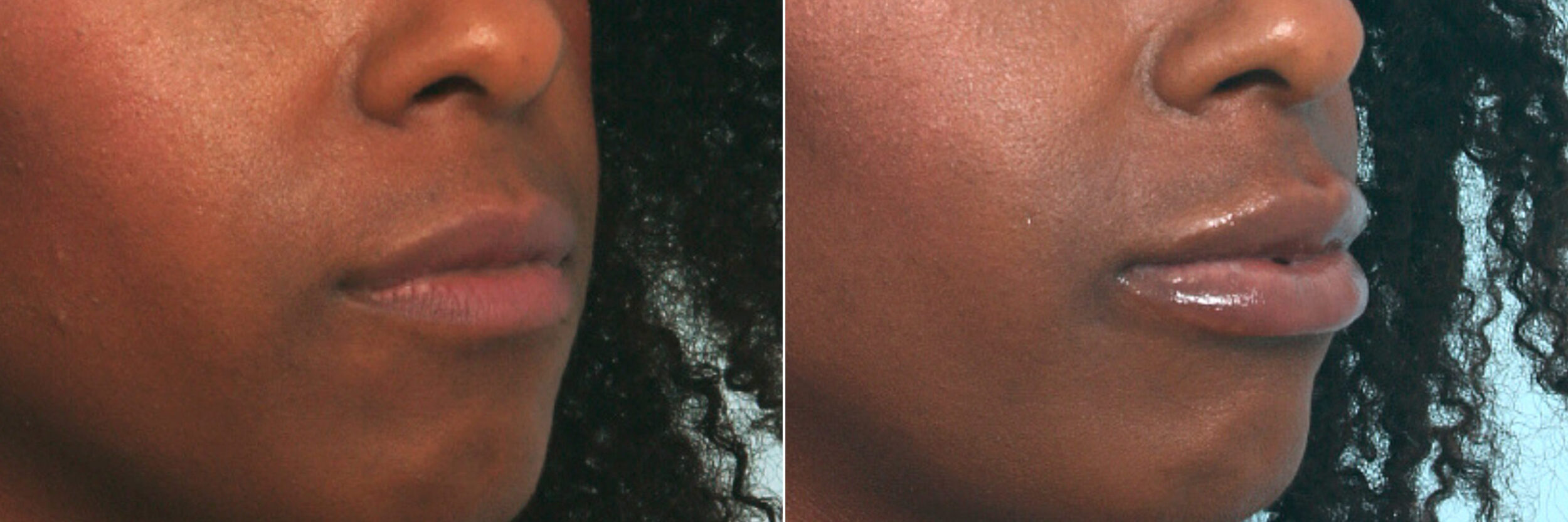 Before and After Image: Lip Enhancement Before and After Photos in Houston, TX, Patient 10093 - right-front-oblique
